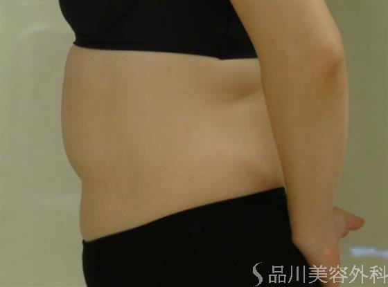 症例NO.41032のBEFORE写真