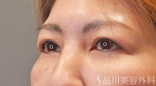 症例NO.75297のAFTER写真