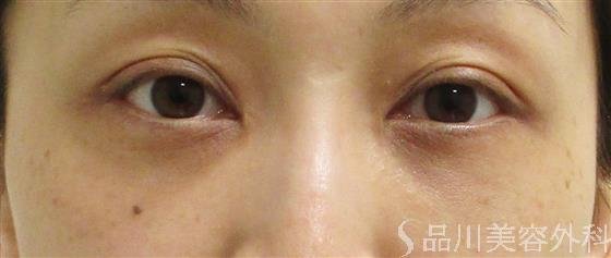 症例NO.55779のAFTER写真
