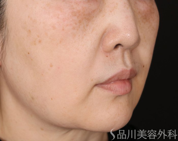 症例NO.72152のBEFORE写真