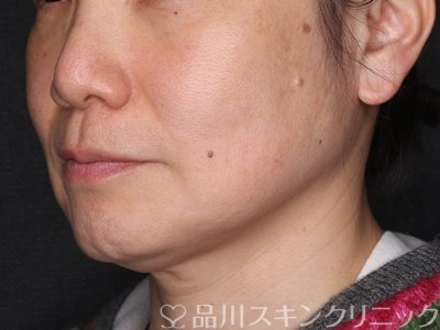 症例NO.71185のBEFORE写真
