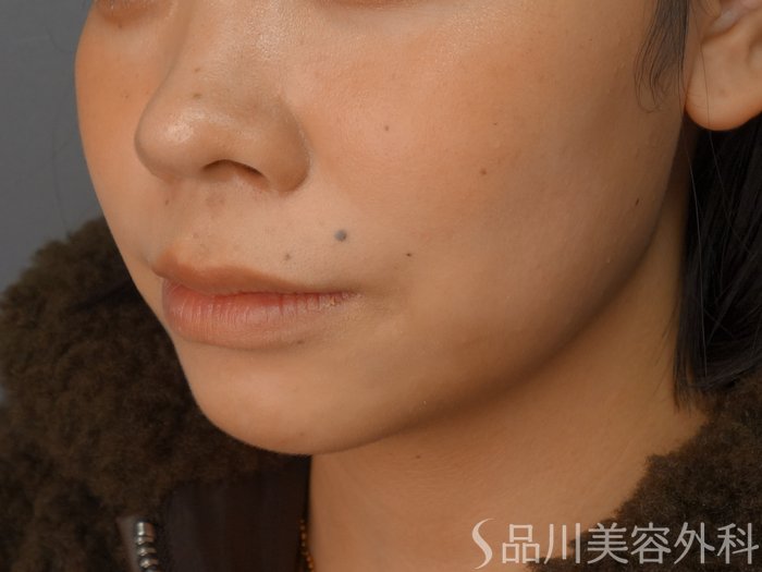 症例NO.73031のBEFORE写真