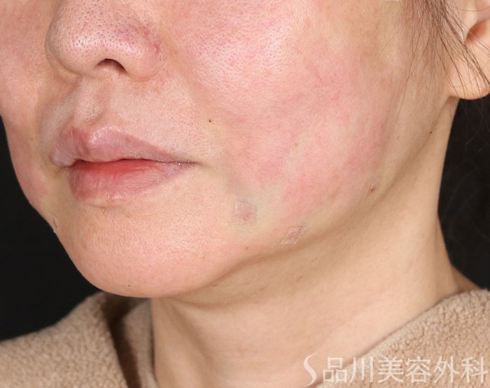 症例NO.72690のAFTER写真