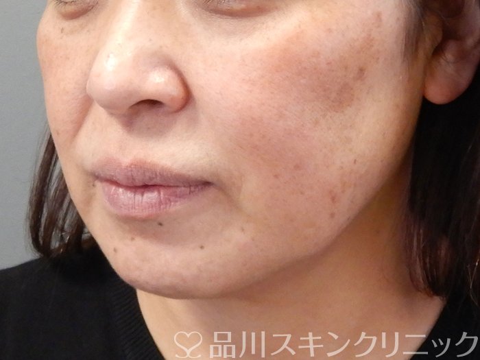 症例NO.69191のBEFORE写真