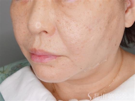 症例NO.53041のAFTER写真