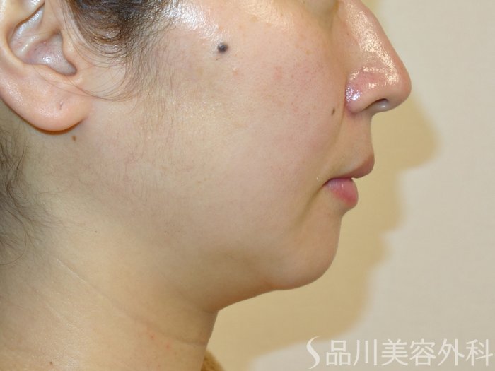 症例NO.73287のBEFORE写真