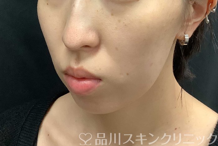 症例NO.69775のBEFORE写真