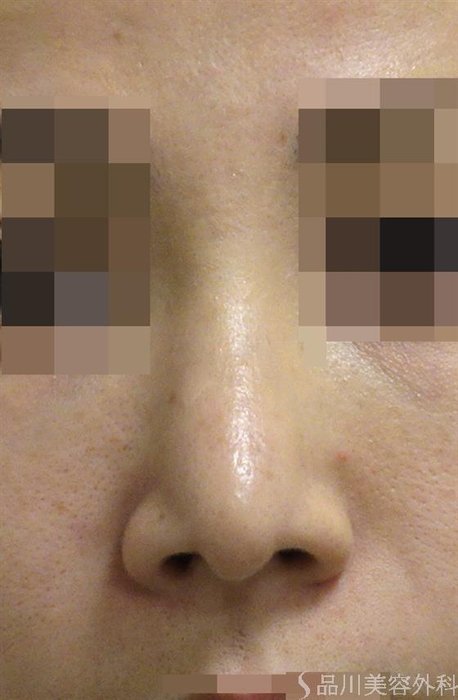 症例NO.47082のAFTER写真
