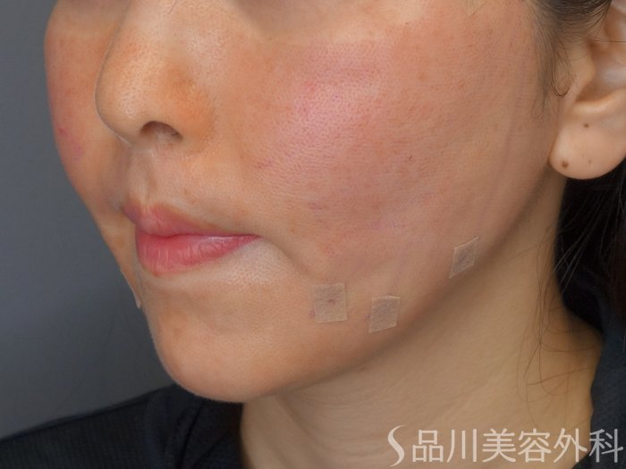 症例NO.73030のAFTER写真