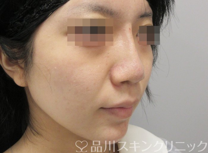 症例NO.71102のAFTER写真
