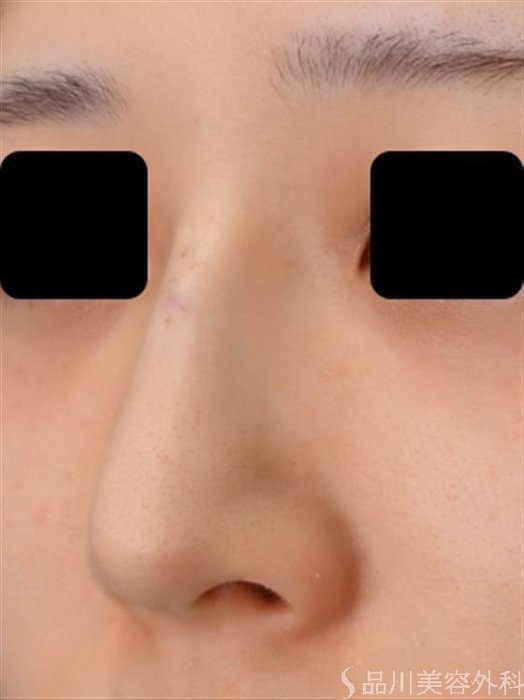 症例NO.51739のAFTER写真