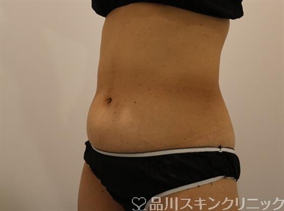症例NO.44064のBEFORE写真