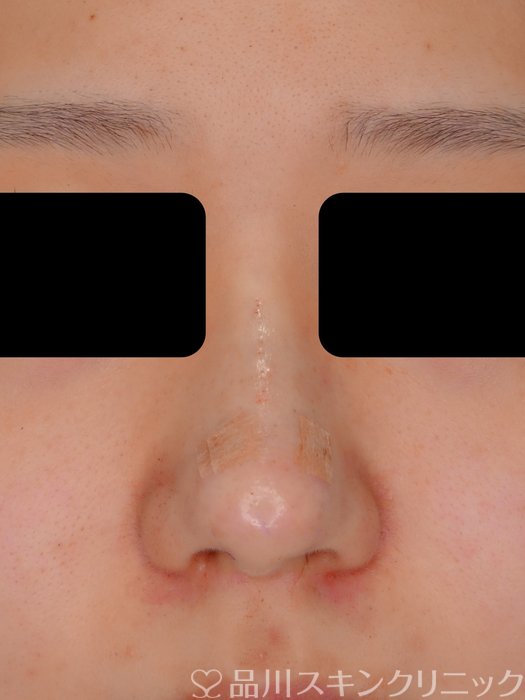 症例NO.73090のBEFORE写真