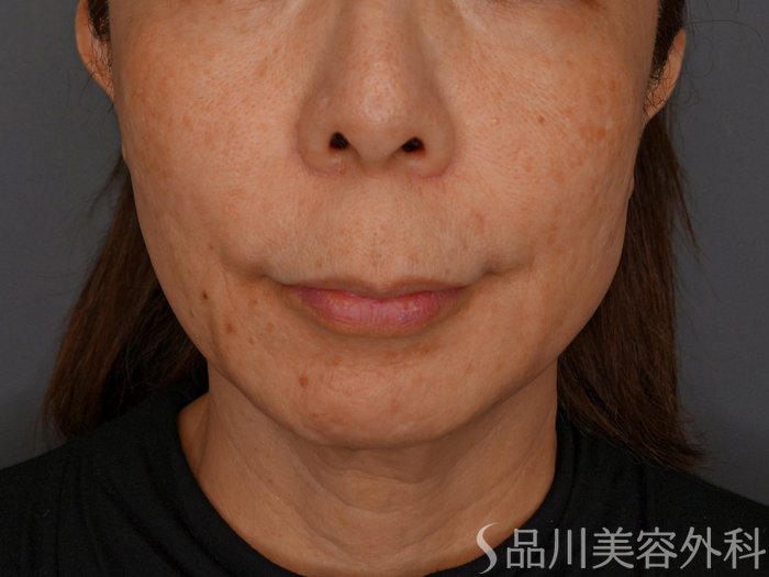 症例NO.74396のBEFORE写真