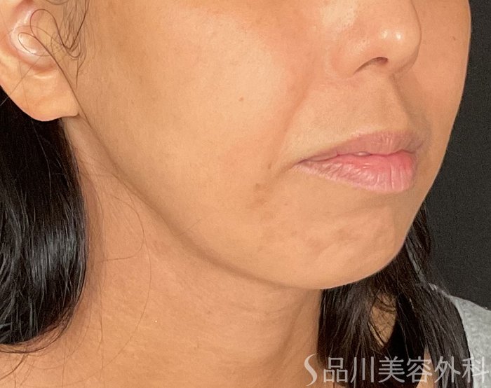 症例NO.74612のBEFORE写真