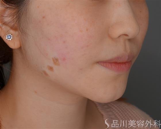 症例NO.51167のAFTER写真