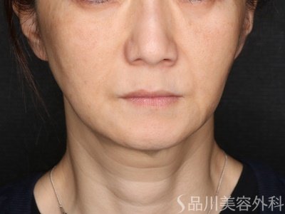 症例NO.73684のAFTER写真