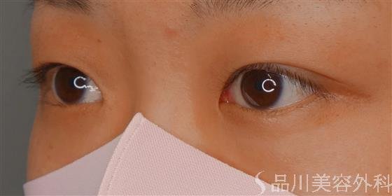 症例NO.59286のBEFORE写真