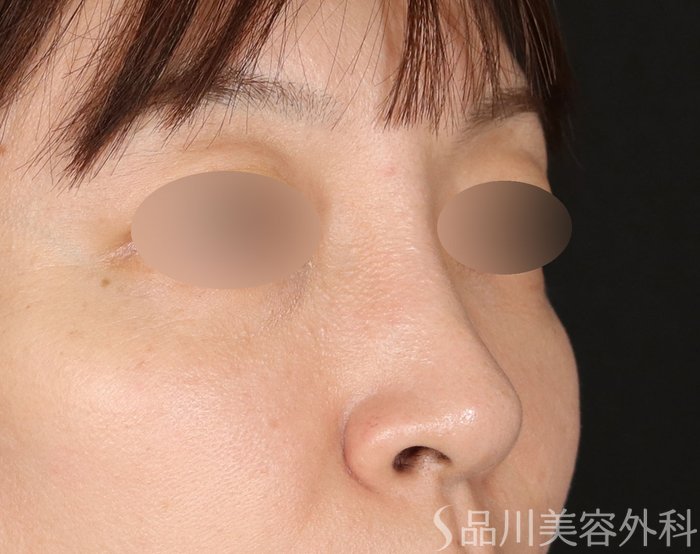 症例NO.71296のBEFORE写真
