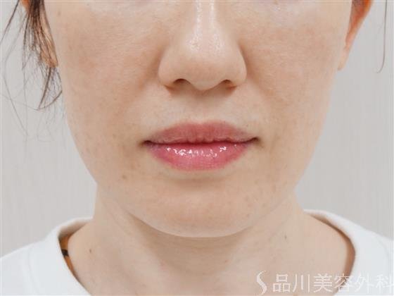 症例NO.39101のBEFORE写真