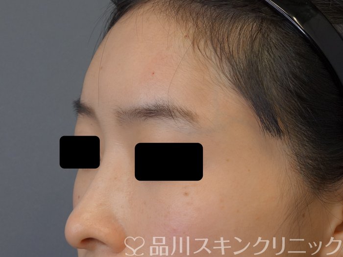 症例NO.74090のAFTER写真