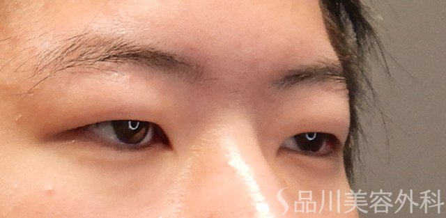 症例NO.72454のBEFORE写真