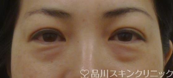 症例NO.38392のBEFORE写真