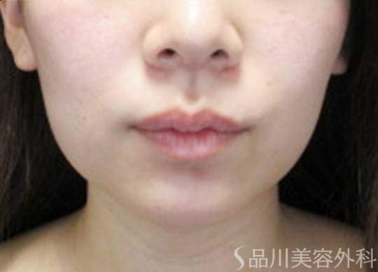 症例NO.73604のBEFORE写真