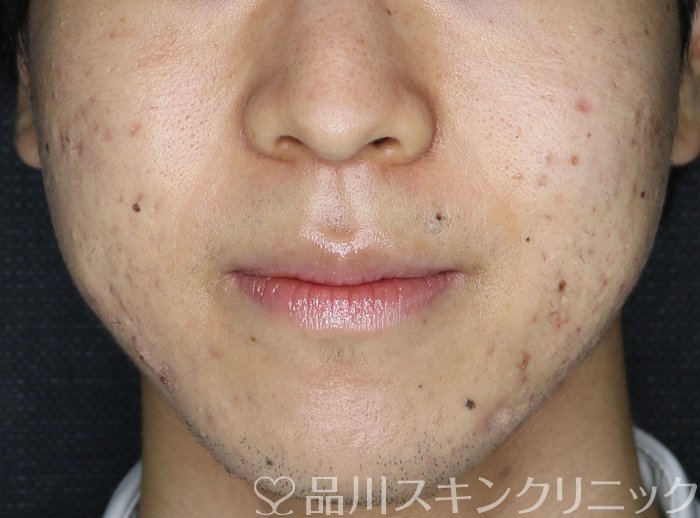 症例NO.69197のAFTER写真