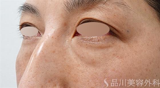 症例NO.50882のBEFORE写真