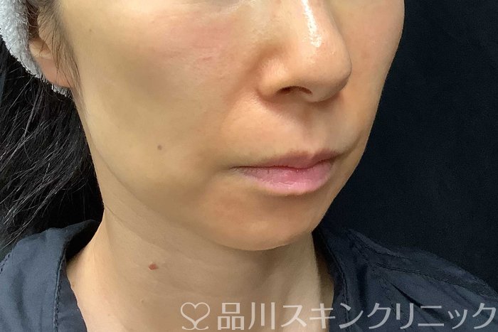 症例NO.69840のBEFORE写真