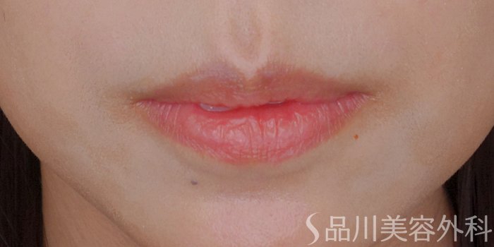 症例NO.72259のBEFORE写真