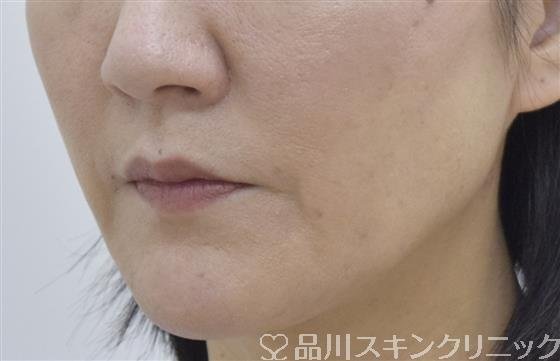 症例NO.53432のAFTER写真