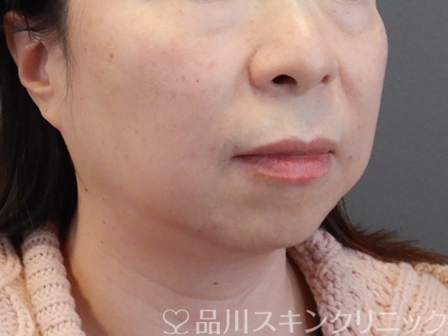 症例NO.69230のAFTER写真