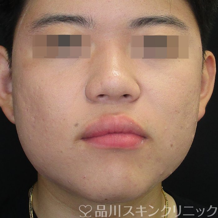 症例NO.73149のBEFORE写真