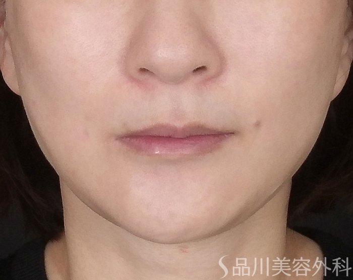 症例NO.67949のAFTER写真