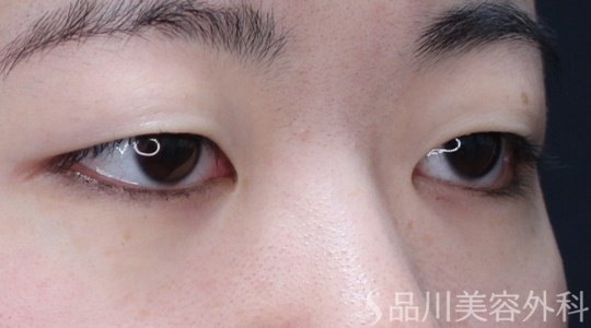 症例NO.69676のBEFORE写真