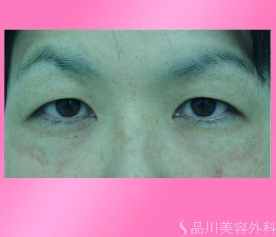 症例NO.2980のBEFORE写真