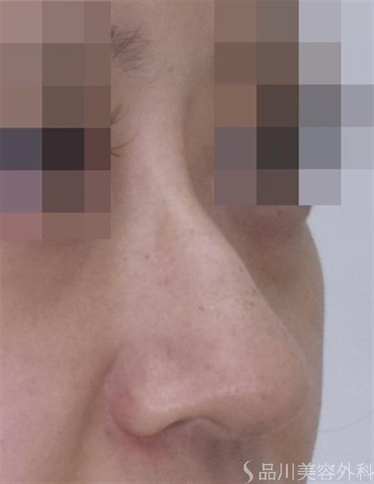症例NO.51562のAFTER写真