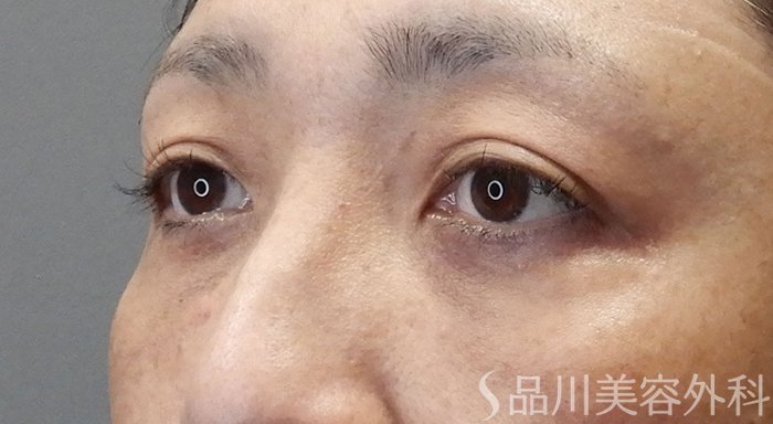 症例NO.70095のAFTER写真