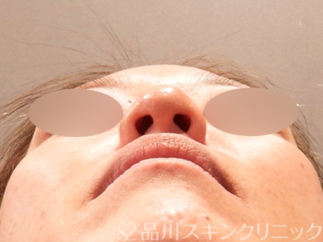症例NO.69576のAFTER写真
