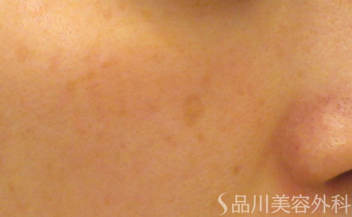 症例NO.74035のBEFORE写真