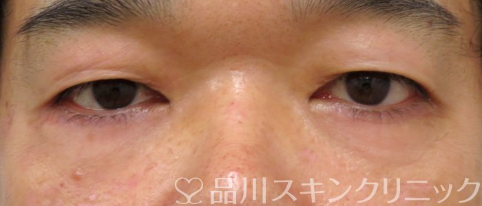 症例NO.75026のAFTER写真