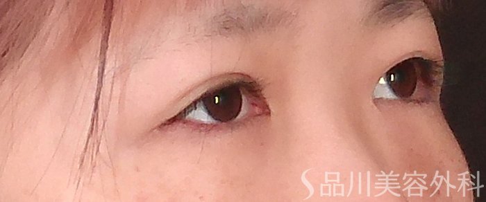 症例NO.69401のAFTER写真
