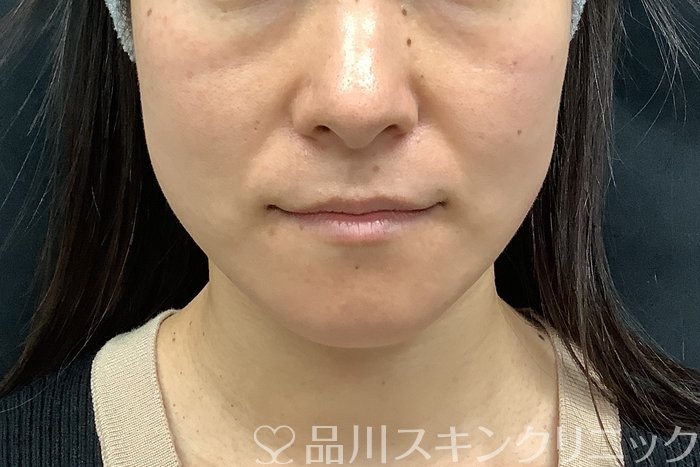 症例NO.71545のBEFORE写真