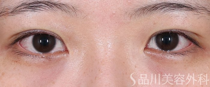 症例NO.71075のAFTER写真