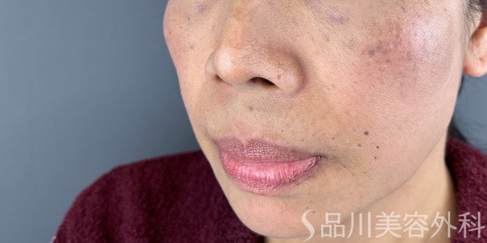症例NO.69505のBEFORE写真
