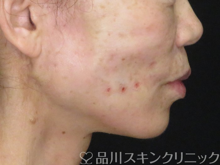 症例NO.70580のAFTER写真