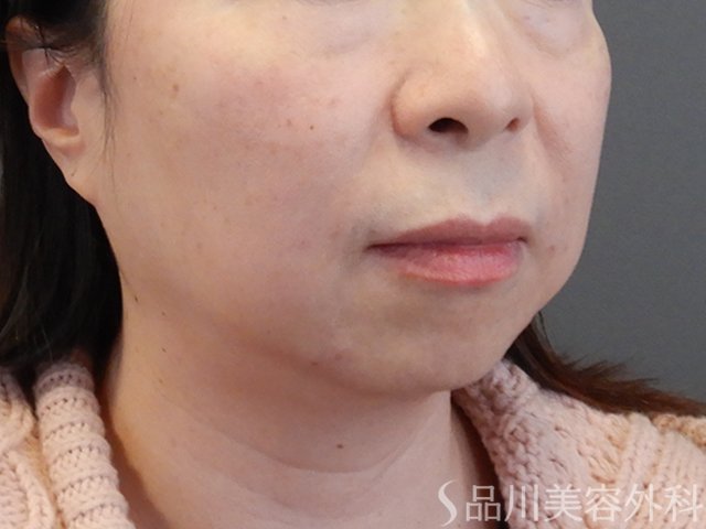 症例NO.69230のAFTER写真