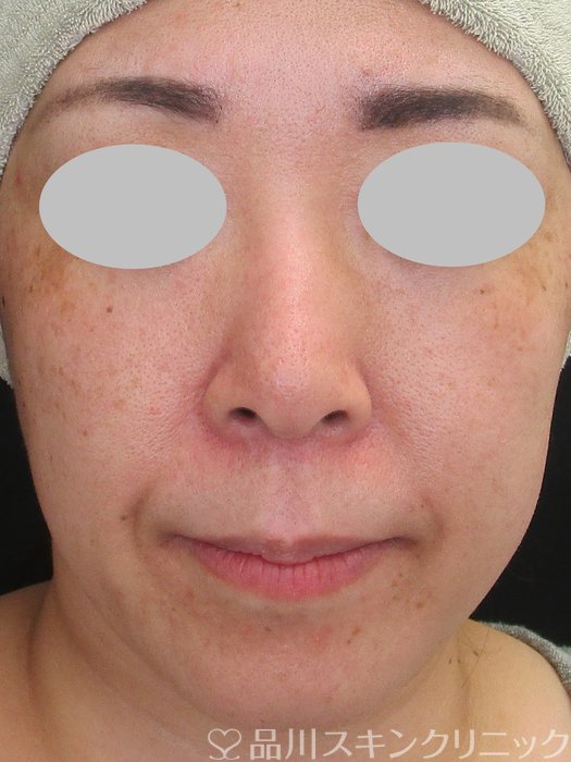 症例NO.73415のBEFORE写真